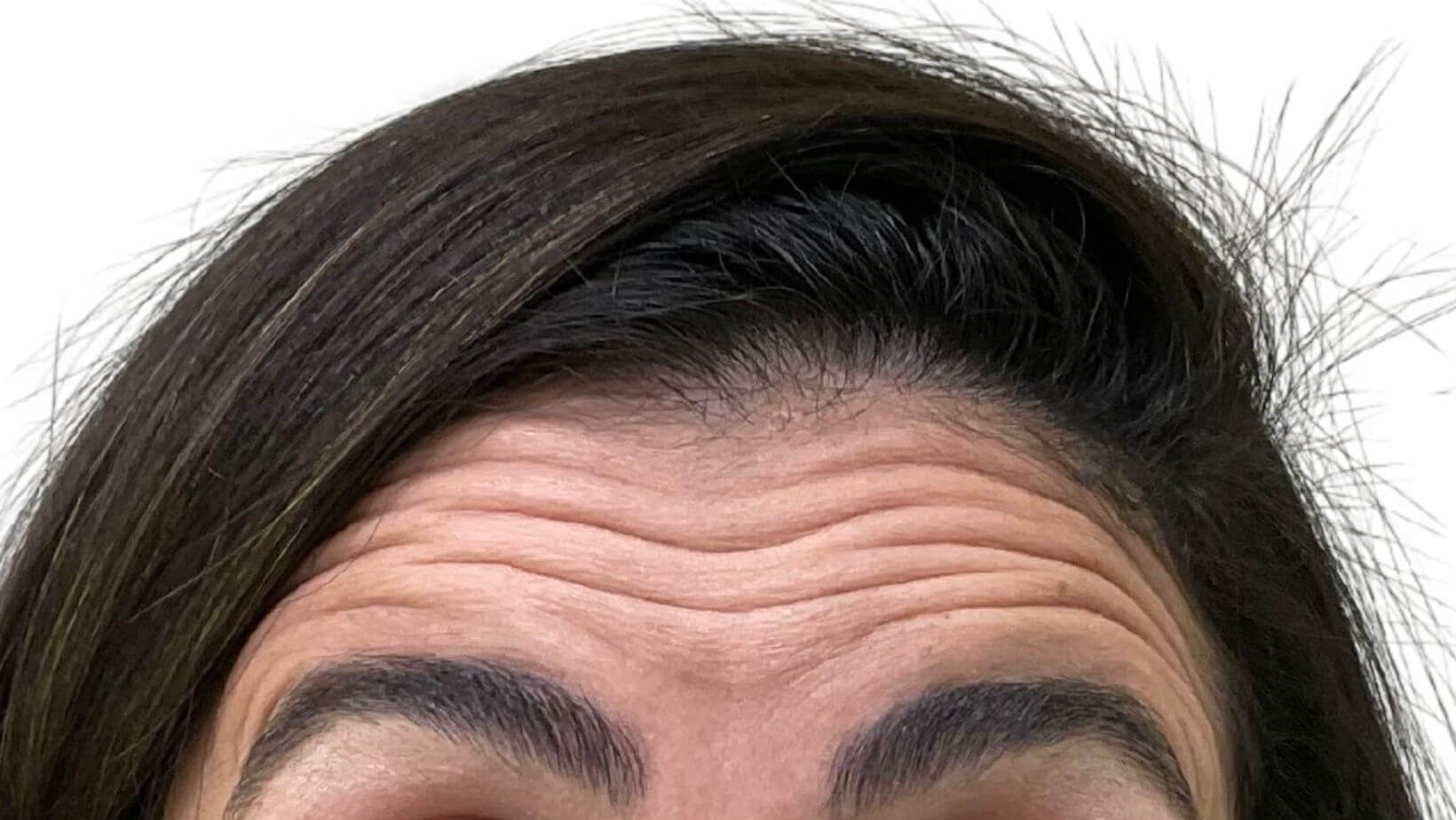 Forehead Lines Anti-Wrinkle Injections | Nova Cosmetic Clinic Sydney CBD